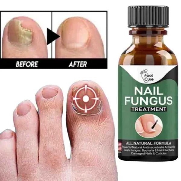 Applying nail repair gel for toenail fungus and damaged nails
